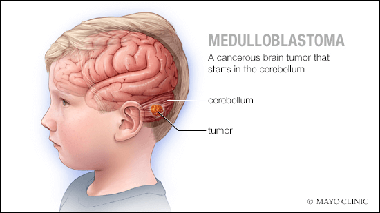 Medulloblastoma