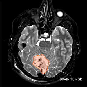 Medulloblastoma