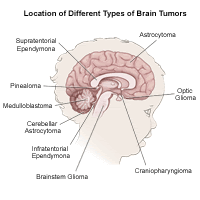 location-of-brain tumors